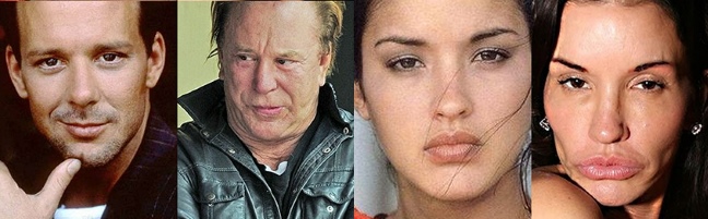 Chirurgie plastique infructueuse. Photos d'hommes et de femmes effrayantes de stars russes et hollywoodiennes