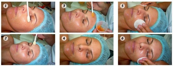 Avantages et inconvénients du peeling du visage: chimique, acides de fruits, glycolique, matériel, rétinol, Jessner, acide succinique, avec du calcium