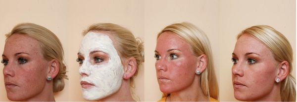 Avantages et inconvénients du peeling du visage: produits chimiques, acides de fruits, glycolique, matériel, rétinol, Jessner, acide succinique, avec du calcium