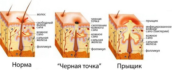 Acné sur le visage. Causes et traitement des remèdes populaires, des antibiotiques, des herbes chez les adolescents et les adultes à la maison