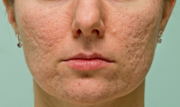 Soins de la peau après le peeling du visage: laser, chimique, fruit, glycolique, matériel, rétinol, Jessner, jaune, TCA, bodyag, acide salicylique