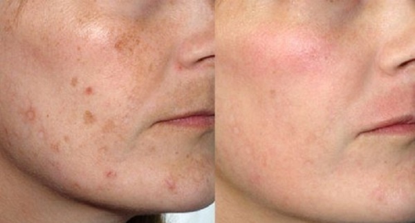 Soins de la peau après le peeling du visage: laser, chimique, fruit, glycolique, matériel, rétinol, Jessner, jaune, TCA, bodyag, acide salicylique