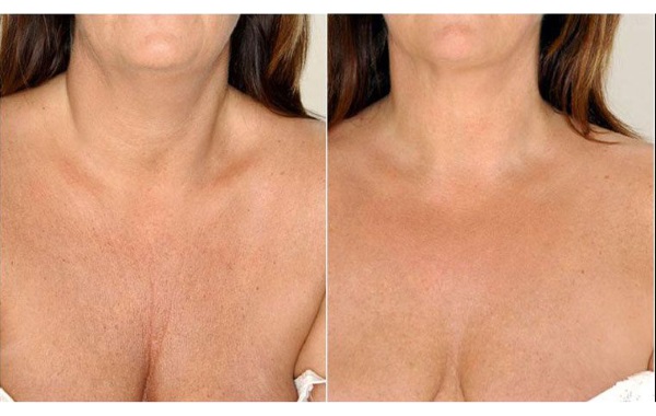 Juvederm hydrate pour la bio-revitalisation. Description du médicament, composition, mode d'emploi, résultats de la photo, prix, avis des cosmétologues