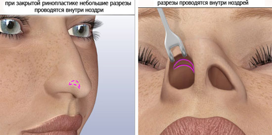 Rhinoplastie du nez, non chirurgicale, fermée, ouverte, reconstructive, injection, rééducation