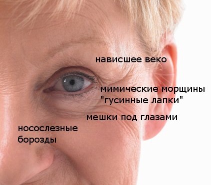 Blépharoplastie.Photos avant et après l'opération des paupières inférieures, supérieures, laser, circulaire, chirurgie plastique par injection des paupières. Comment est l'opération, la réhabilitation, les avis et les prix