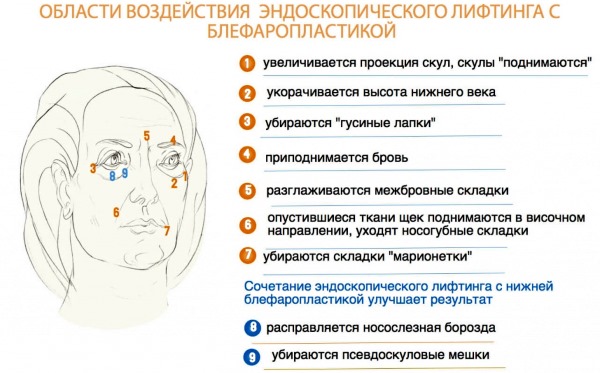 Blépharoplastie. Photos avant et après l'opération des paupières inférieures, supérieures, laser, circulaire, chirurgie plastique par injection des paupières. Comment est l'opération, la réhabilitation, les avis et les prix