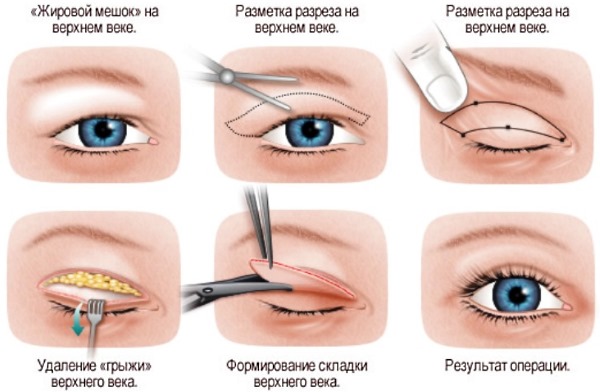 Blépharoplastie. Photos avant et après l'opération des paupières inférieures, supérieures, laser, circulaire, chirurgie plastique par injection des paupières. Comment est l'opération, la réhabilitation, les avis et les prix