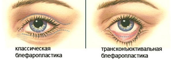 Blépharoplastie. Photos avant et après l'opération des paupières inférieures, supérieures, laser, circulaire, chirurgie plastique par injection des paupières. Comment est l'opération, la réhabilitation, les avis et les prix