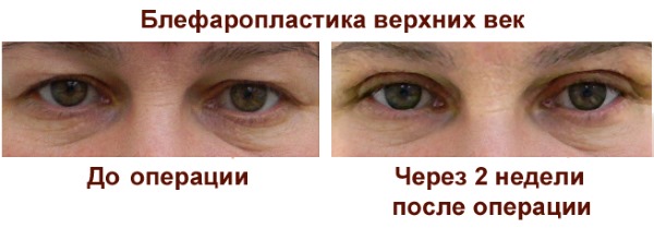 Blépharoplastie. Photos avant et après l'opération des paupières inférieures, supérieures, laser, circulaire, chirurgie plastique par injection des paupières. Comment est l'opération, la réhabilitation, les avis et les prix