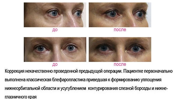 Blépharoplastie. Photos avant et après l'opération des paupières inférieures, supérieures, laser, circulaire, chirurgie plastique par injection des paupières. Comment est l'opération, la réhabilitation, les avis et les prix