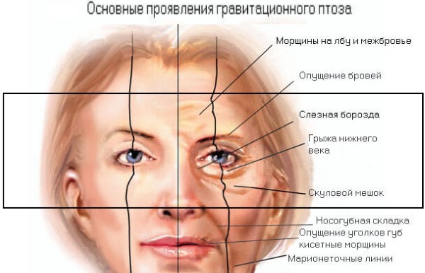 Blépharoplastie. Photos avant et après l'opération des paupières inférieures, supérieures, laser, circulaire, chirurgie plastique par injection des paupières. Comment est l'opération, la réhabilitation, les avis et les prix