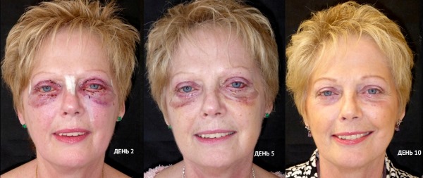 Blépharoplastie. Photos avant et après l'opération des paupières inférieures, supérieures, laser, circulaire, chirurgie plastique par injection des paupières. Comment est l'opération, la réhabilitation, les avis et les prix