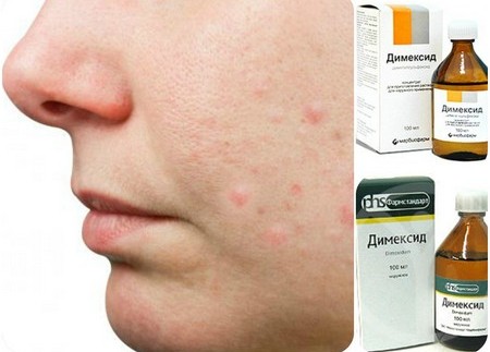 Talker pour l'acné. Recette de dermatologue avec lévomycétine et acide salicylique. Comment préparer et utiliser