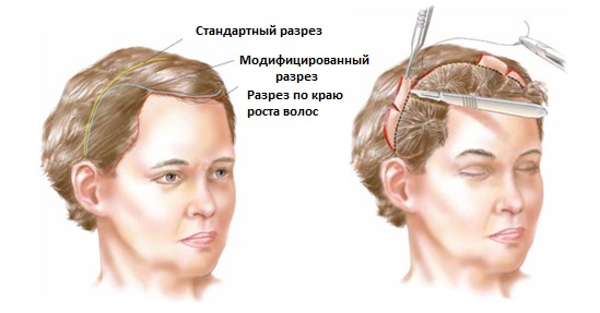 Lifting endoscopique: front et sourcils, cou, pommettes, partie temporale. Comment ça se passe, photos, rééducation et conséquences