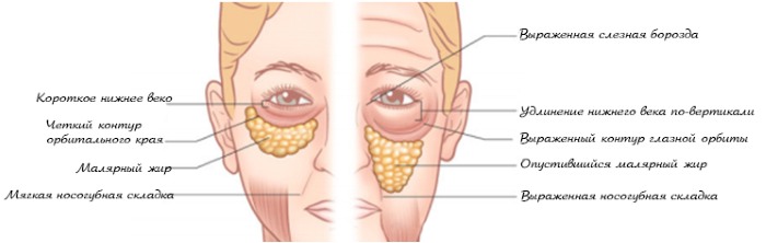 Lifting endoscopique: front et sourcils, cou, pommettes, partie temporale. Comment ça se passe, photos, rééducation et conséquences