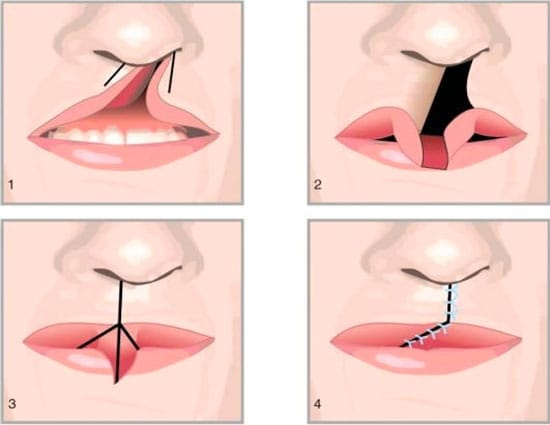 Chéiloplastie des lèvres: photos avant et après, types, indications et contre-indications. Comment se déroulent l'opération et la réhabilitation?