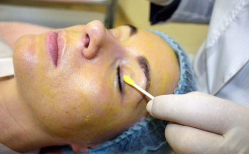 Peeling chimique pour le visage au salon et à la maison. Avis, photos avant et après, avantages et inconvénients