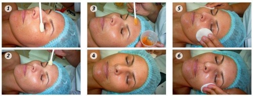 Peeling chimique pour le visage au salon et à la maison. Avis, photos avant et après, avantages et inconvénients