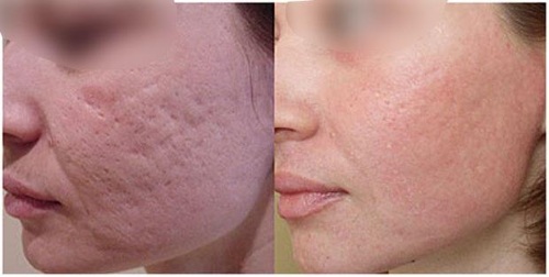 Peeling chimique pour le visage au salon et à la maison. Avis, photos avant et après, avantages et inconvénients