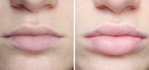 Comment agrandir les lèvres avec de l'acide hyaluronique, du botox, du silicone, du lipofilling, de la cheiloplastie. Résultats: photos avant et après, prix, avis