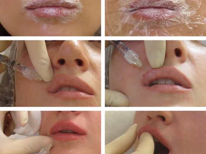 Comment agrandir les lèvres avec de l'acide hyaluronique, du botox, du silicone, du lipofilling, de la cheiloplastie. Résultats: photos avant et après, prix, avis