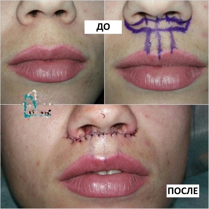 Comment agrandir les lèvres avec de l'acide hyaluronique, du botox, du silicone, du lipofilling, de la cheiloplastie. Résultats: photos avant et après, prix, avis