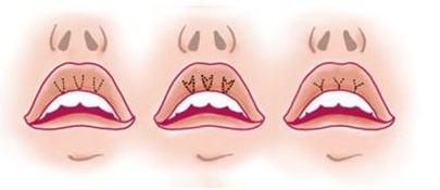 Comment agrandir les lèvres avec de l'acide hyaluronique, du botox, du silicone, du lipofilling, de la cheiloplastie. Résultats: photos avant et après, prix, avis