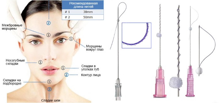 Lifting circulaire. Photos avant et après, le prix, comment l'opération est réalisée chirurgicalement, avec des fils, et sans chirurgie. Avis et prix