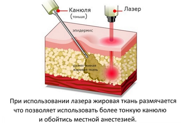 Liposuccion du menton avec laser. Photos, comment la procédure est effectuée, la période de rééducation, les conséquences, les critiques