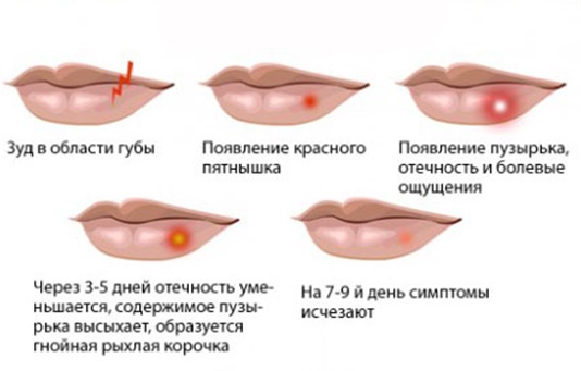 Pommades pour les cicatrices et les cicatrices sur le visage après l'acné, la varicelle, la blépharoplastie, la chirurgie.Des moyens efficaces et peu coûteux