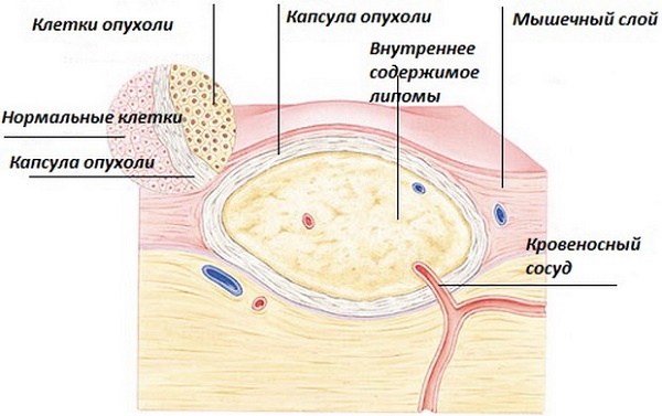 Néoplasmes cutanés: photos et descriptions sur la tête, les bras, le visage et le corps. Comment traiter les néoplasmes bénins et malins