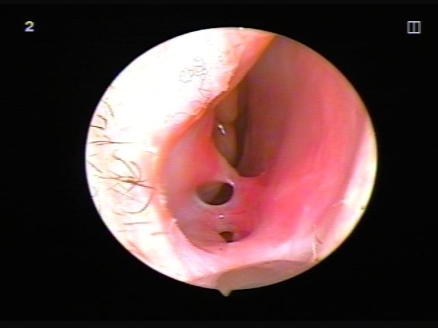 Chirurgie de la cloison nasale: période postopératoire, soins du nez après correction, rééducation. Une photo