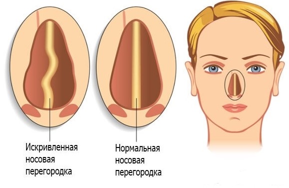 Chirurgie de la cloison nasale: période postopératoire, soins du nez après correction, rééducation. Une photo