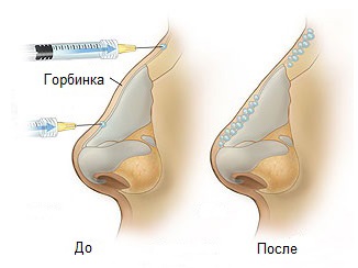 Chirurgie de réduction du nez: ailes, pointe, comment ça marche, photos avant et après