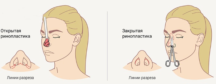 Chirurgie de réduction du nez: ailes, pointe, comment ça marche, photos avant et après