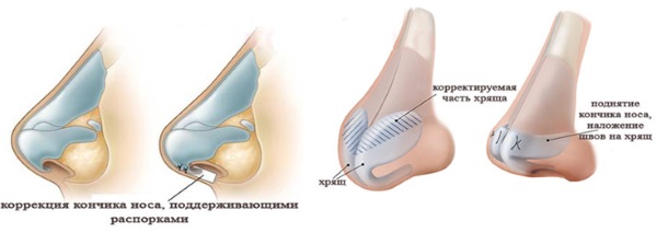 Chirurgie de réduction du nez: ailes, pointe, comment ça marche, photos avant et après