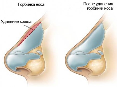 Chirurgie de réduction du nez: ailes, pointe, comment ça marche, photos avant et après