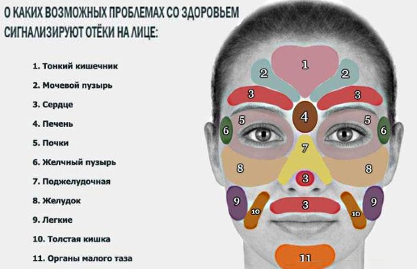 Gonflement sous les yeux le matin. Causes et traitement chez les femmes et les hommes, ecchymoses matinales, rougeurs, poches sur les pommettes