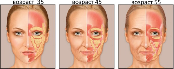 Gonflement sous les yeux le matin. Causes et traitement chez les femmes et les hommes, ecchymoses matinales, rougeurs, poches sur les pommettes