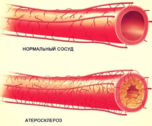 Thérapie à l'ozone intraveineuse. Examens des médecins, indications et contre-indications, avantages et inconvénients, cours du traitement, est-il possible d'effectuer pendant la grossesse