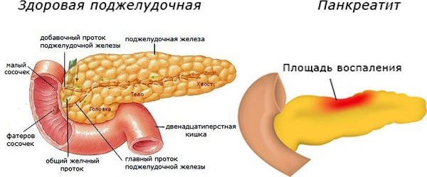 Thérapie à l'ozone intraveineuse. Examens des médecins, indications et contre-indications, avantages et inconvénients, cours du traitement, est-il possible d'effectuer pendant la grossesse