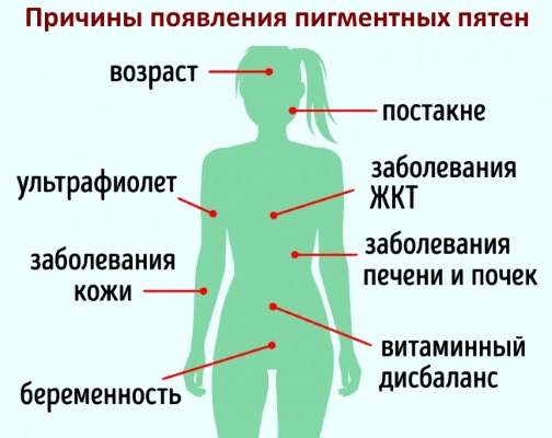 Pigmentation sur le visage. Causes et traitement à domicile. Crèmes, pommades, remèdes populaires, masques, élimination au laser