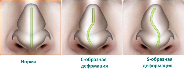 Rhinoplastie du nez, non chirurgicale, fermée, ouverte, reconstructive, injection, rééducation