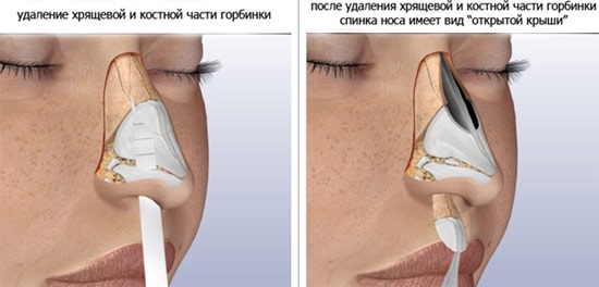 Rhinoplastie du nez, non chirurgicale, fermée, ouverte, reconstructive, injection, rééducation