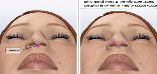 Rhinoplastie du nez, non chirurgicale, fermée, ouverte, reconstructive, injection, rééducation