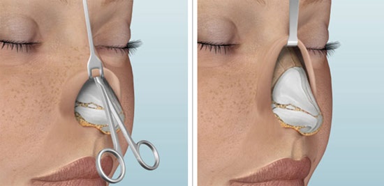 Rhinoplastie du nez, non chirurgicale, fermée, ouverte, reconstructive, injection, rééducation