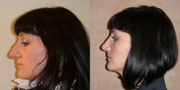 Rhinoplastie du nez, non chirurgicale, fermée, ouverte, reconstructive, injection, rééducation