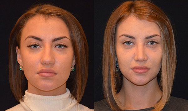 Rhinoplastie du nez, non chirurgicale, fermée, ouverte, reconstructive, injection, rééducation