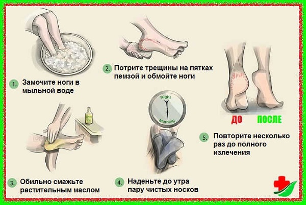 Remèdes pour les talons fissurés: folk avec glycérine, ammoniaque, vinaigre, œuf, peroxyde, aloès, vitamine E, calendula