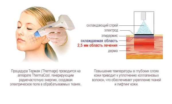 Thermage facial - quelle est cette procédure, comment est-elle effectuée, quelle est la différence avec le levage RF. Photos, résultats, prix, avis